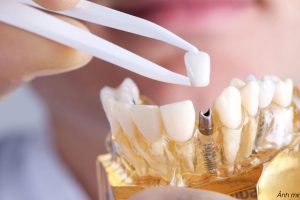 Câu hỏi thường gặp về tuyển sinh kỹ thuật phục hình răng 2023
